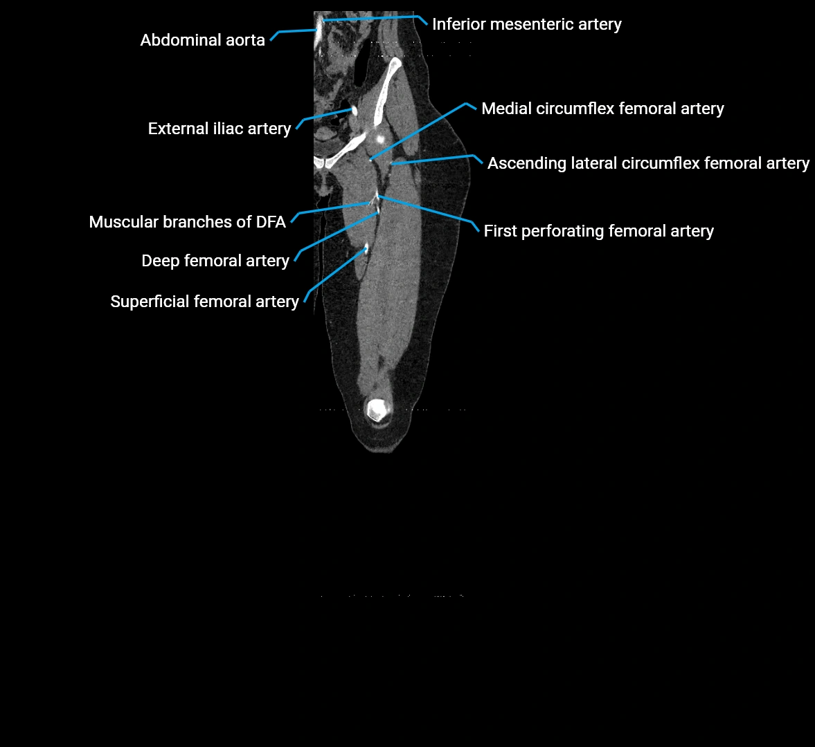 CTA lower limb coronal cross sectional anatomy labelled image _23 (2).webp